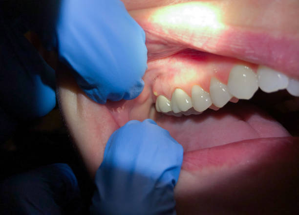Best Emergency Dentist for Lost Fillings or Crowns in Clinton, NY